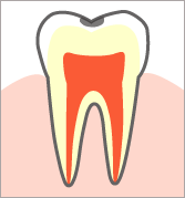 エナメル質の虫歯(C1)