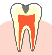 象牙質に達する虫歯(C2)